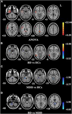 Altered Fractional Amplitude of Low-Frequency Fluctuation in Major Depressive Disorder and Bipolar Disorder